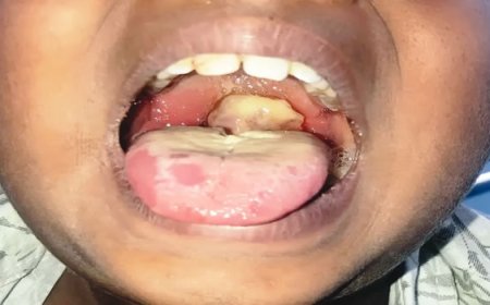 Resurgence of diphtheria: A public health concern in Nigeria.