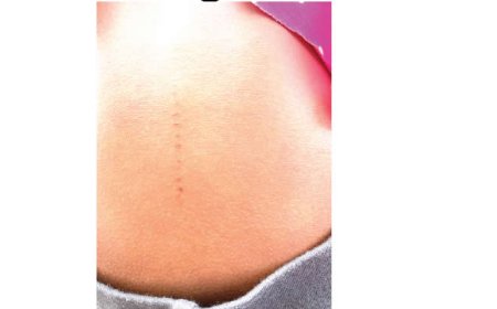 Parents tackle Ogun school over incisions on children’s bodies