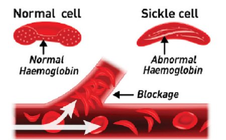 Love or Lies?: Fake genotype results fuel rise in sickle cell births, broken homes
