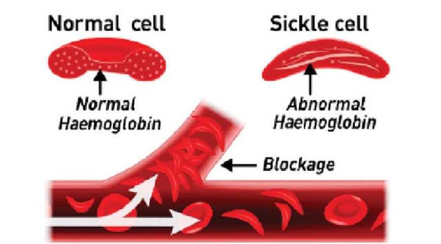 Love or Lies?: Fake genotype results fuel rise in sickle cell births, broken homes