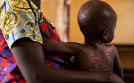 Foundation seeks state funding for measles vaccination drive