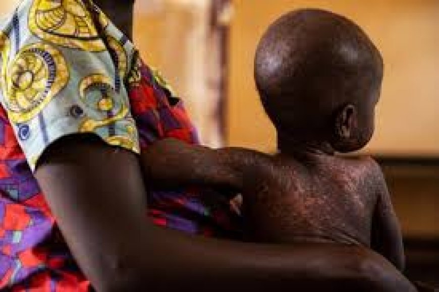 Foundation seeks state funding for measles vaccination drive