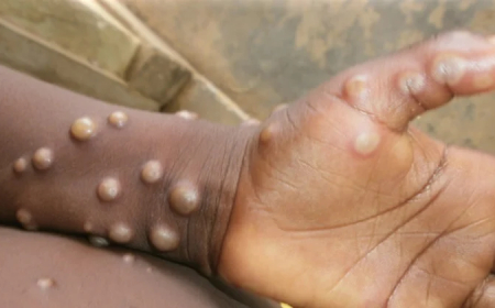 Africa records over 61,000 Mpox cases, seeks treatment options
