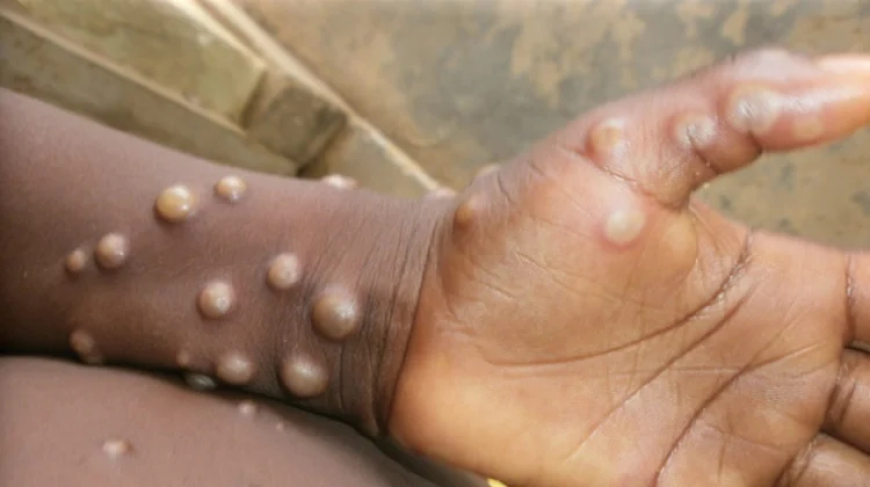 Africa records over 61,000 Mpox cases, seeks treatment options