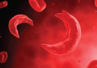 Coalition wants mandatory genotype tests before marriage to curb sickle cell